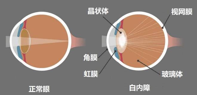 半岛体育白内障逐渐年轻化这几类人都易患病！出现这些症状及时就医！(图2)