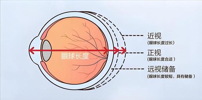 半岛体育视光之海：如何延缓近视进展(图1)